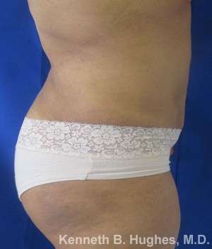 Liposuction Before & After Patient #9240