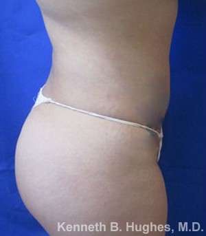 Liposuction Before & After Patient #9245