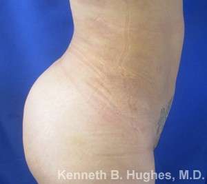 Liposuction Before & After Patient #9255