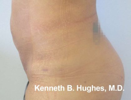 Liposuction Before & After Patient #9284