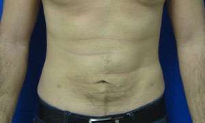 Liposuction Before & After Patient #9310