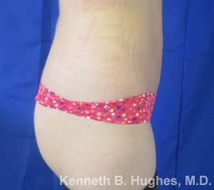 Liposuction Before & After Patient #9323