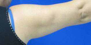Liposuction Before & After Patient #9422
