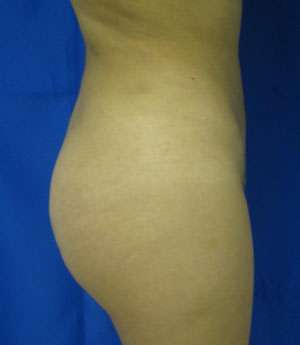 Liposuction Before & After Patient #9439