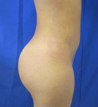 Liposuction Before & After Patient #9467