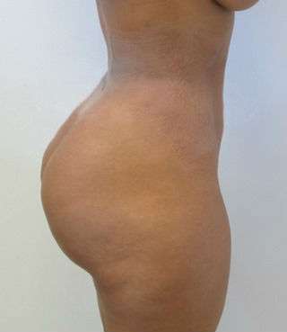 Liposuction Before & After Patient #9472