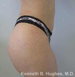 Liposuction Before & After Patient #9519