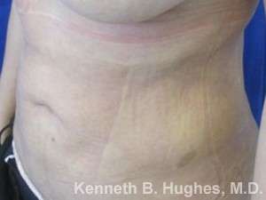 Liposuction Revision Cellulite Reduction Before & After Patient #9658