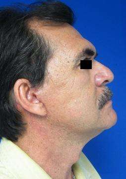 Male Brow Lift Before & After Patient #9679