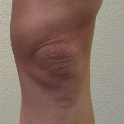 Bodytite Before & After Patient #6149