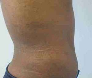 Male Liposuction Before & After Patient #9745