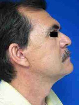 Male Neck Lift Before & After Patient #9774