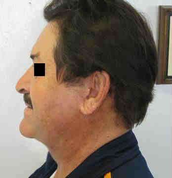 Male Neck Lift Before & After Patient #9779