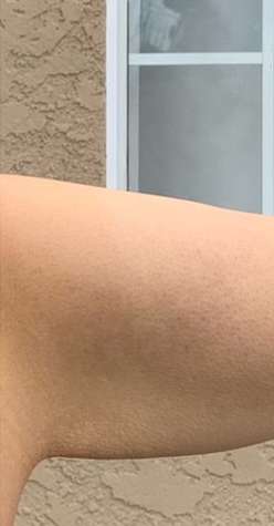 Bodytite Before & After Patient #6164