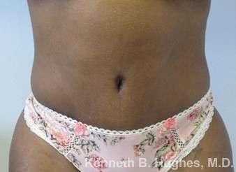 Mommy Makeover Before & After Patient #9977