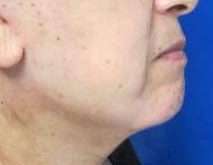 Neck Lift Before & After Patient #10026