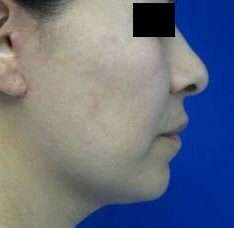 Neck Lift Before & After Patient #10060