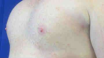 Pec Implants Before & After Patient #10068