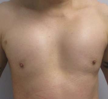 Pec Implants Before & After Patient #10073