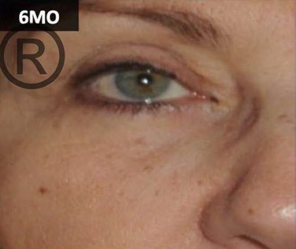 PRP for Facial Rejuvenation Before & After Patient #10078