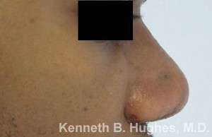 Rhinoplasty Before & After Patient #10110