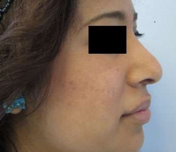 Rhinoplasty Before & After Patient #10147