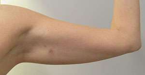 Bodytite Before & After Patient #6189
