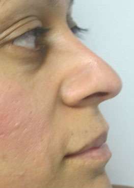 Rhinoplasty Before & After Patient #10175