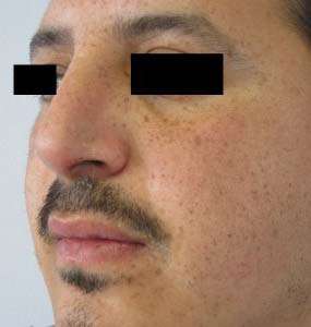 Rhinoplasty Before & After Patient #10188
