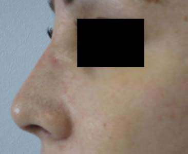 Rhinoplasty Before & After Patient #10196
