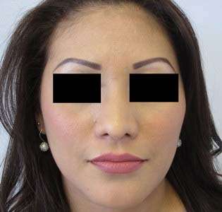 Rhinoplasty Before & After Patient #10201