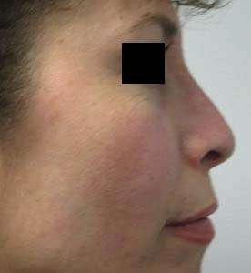 Rhinoplasty Before & After Patient #10239