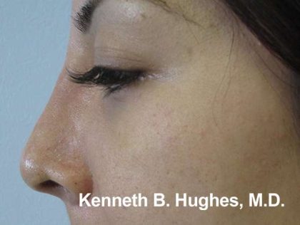 Rhinoplasty Before & After Patient #10250