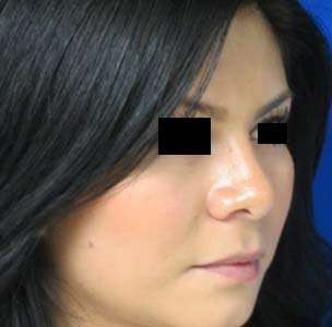 Rhinoplasty Before & After Patient #10261
