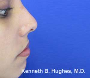 Rhinoplasty Before & After Patient #10277