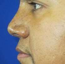 Rhinoplasty Before & After Patient #10288