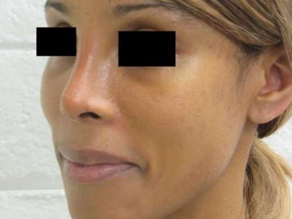 Rhinoplasty Before & After Patient #10318