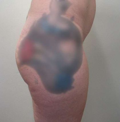 Silicone Injections Biopolymer Removal Before & After Patient #10337