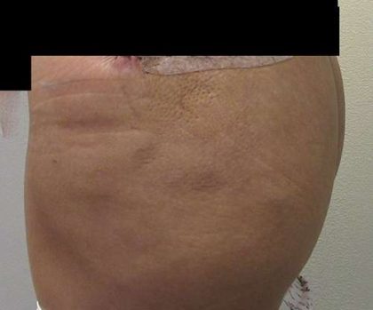 Silicone Injections Biopolymer Removal Before & After Patient #10347