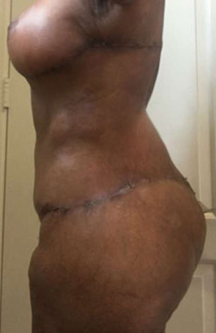 Thigh Lift Before & After Patient #10360