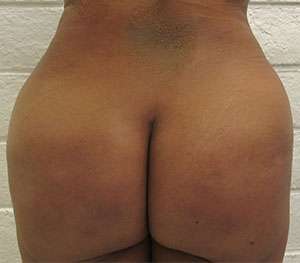 Tummy Tuck Before & After Patient #10410