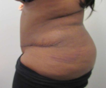 Tummy Tuck Before & After Patient #10418