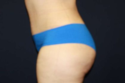 Tummy Tuck Before & After Patient #10423
