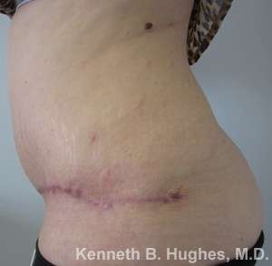Tummy Tuck Before & After Patient #10430