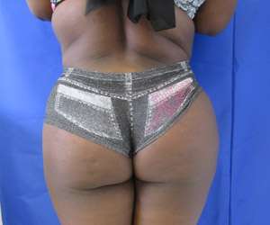Tummy Tuck Before & After Patient #10495