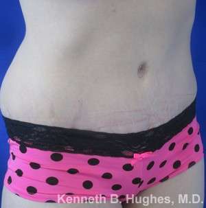 Tummy Tuck Before & After Patient #10508