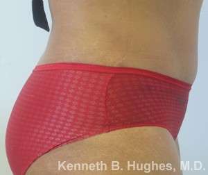 Tummy Tuck Before & After Patient #10539