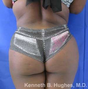 Tummy Tuck Before & After Patient #10604