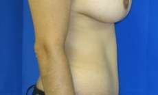 Tummy Tuck Before & After Patient #10639