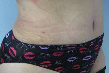 Tummy Tuck Before & After Patient #10737